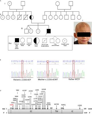 Case Report: Interleukin-2 Receptor Common Gamma Chain Defect Presented as a Hyper-IgE Syndrome